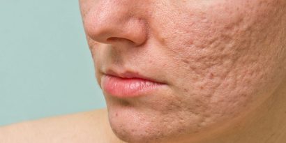 post acne