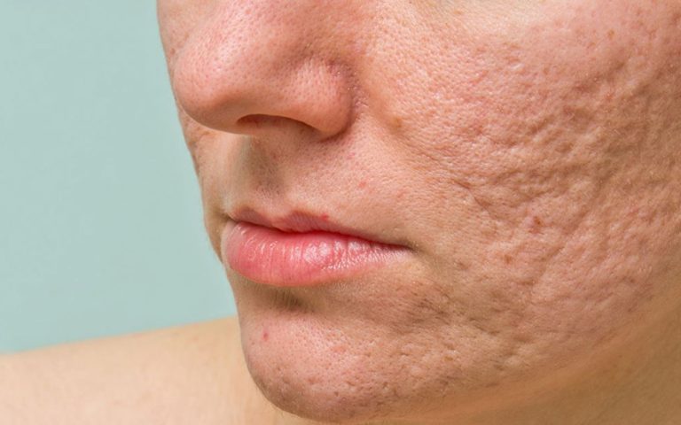 post acne